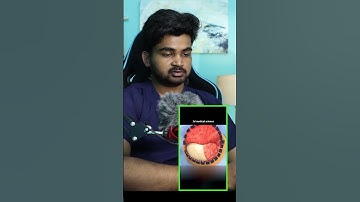 Doctor Explains | BRAIN Surgery animation !!