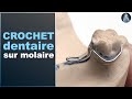 Crochet dentaire jonc sur molaire  prothse amovible partielle  prothse dentaire  