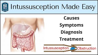 Intussusception: Causes, Symptoms, Diagnosis, Treatment [Nursing, USMLE] by EZmed 66,338 views 2 years ago 8 minutes, 21 seconds