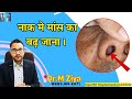 नाक में मांस बढ़ना. Turbinate hypertrophy.