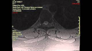 Thoracic spine MRI.wmv