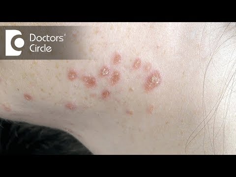 Treatment of severe, longstanding Cystic Acne?-Dr. Rasya Dixit