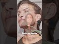 There’s no ‘perfect age’ for FaceTite or a facelift