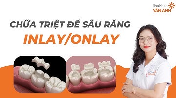 Chữa triệt để răng sâu vỡ lớn bằng phương pháp inlay/onlay | Nha khoa Vân Anh