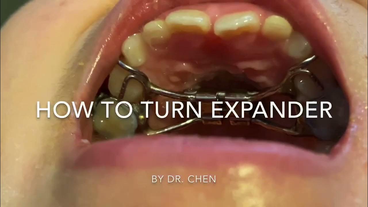 How to Turn Your Orthodontic Expander Appliance YouTube