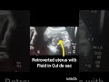 Ultrasound Pelvis!Pelvic Scan showing PID!UTERUS!#ultrasoundmadeeasy86#radiology#viralshort#UK#usa
