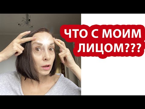 Вот вам и уколы красоты! Что с лицом?