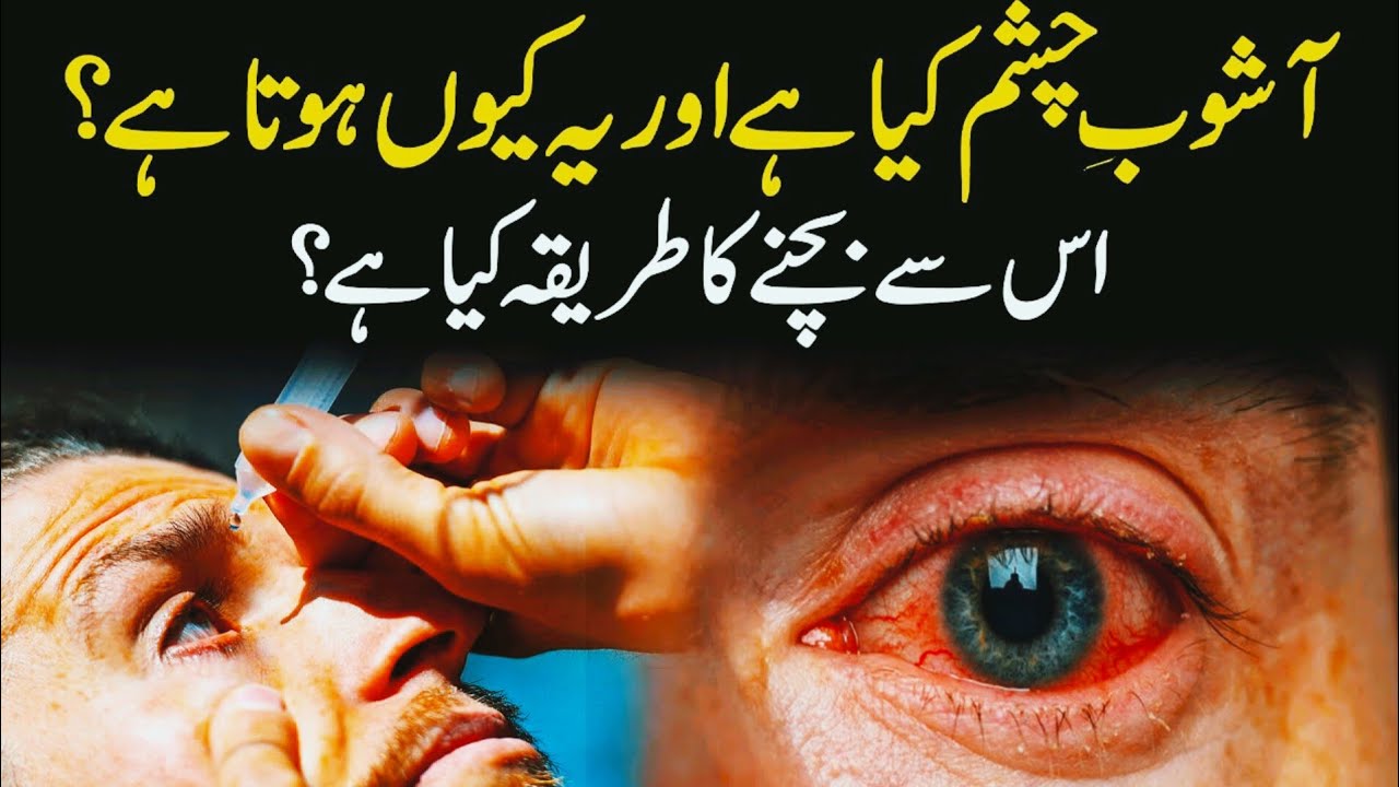  Eyes Infection in Karachi ashob e chashm ka ilaj in urdu ashob e