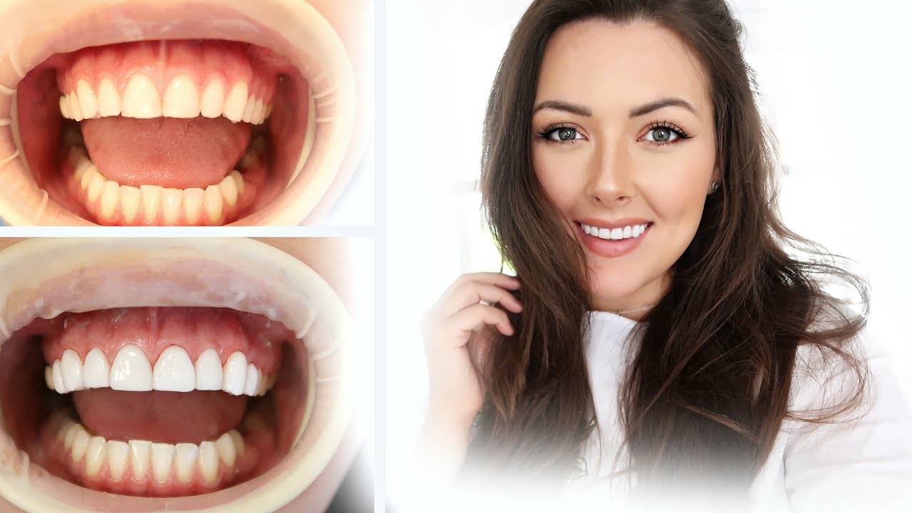 MY SMILE TRANSFORMATION GETTING EMAX VENEERS COME WITH ME MAMA