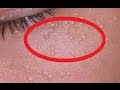 【衝撃】あったらヤバイ?目の周りにできる白いポツポツの正体とは…【知らないと損】
