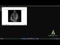 EchoTracker: Revolutionizing Tissue Tracking in Echocardiography