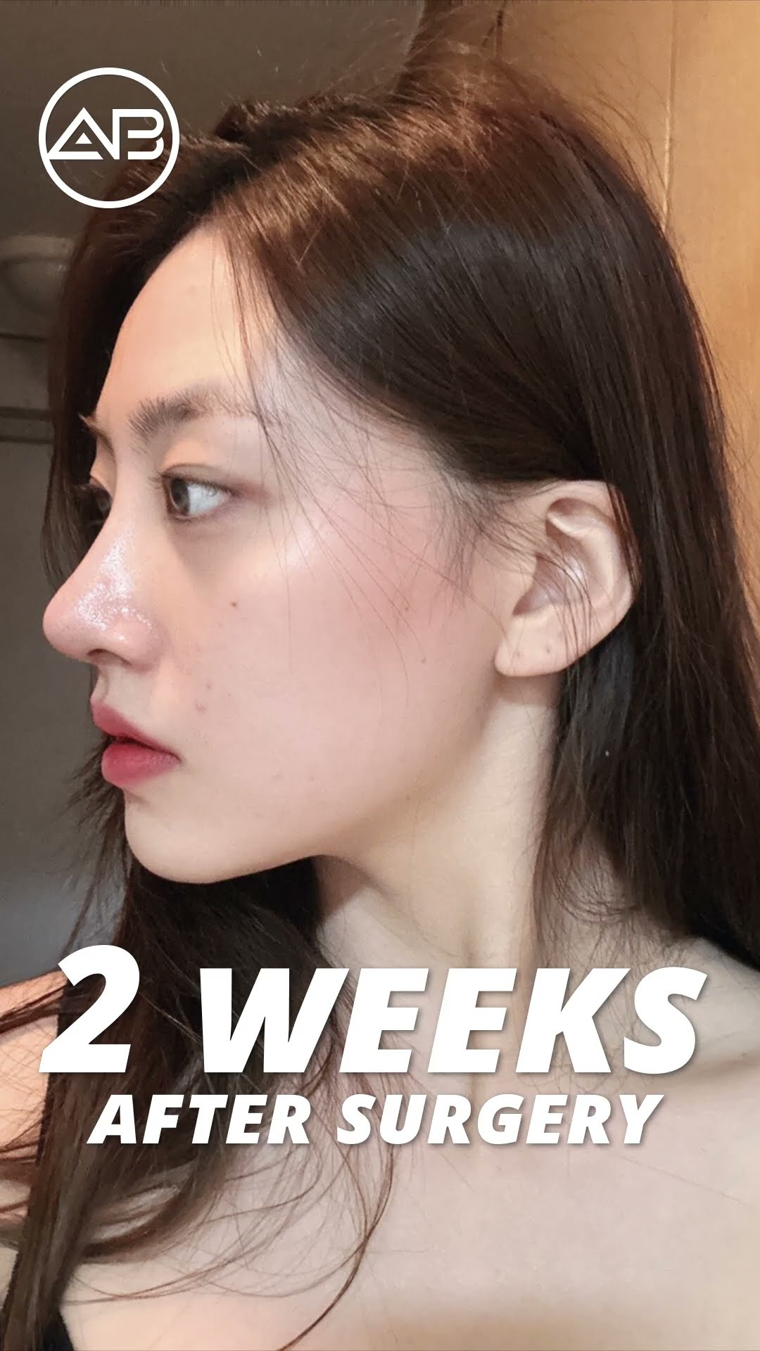 [Plastic surgery in Korea] Revision Rhinoplasty #abplasticsurgery
