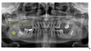 Opg Signs Of Close 3Rd Molar Apex To Id C