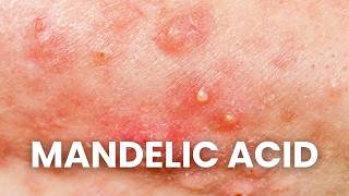WHY Mandelic Acid is Best For ACNE