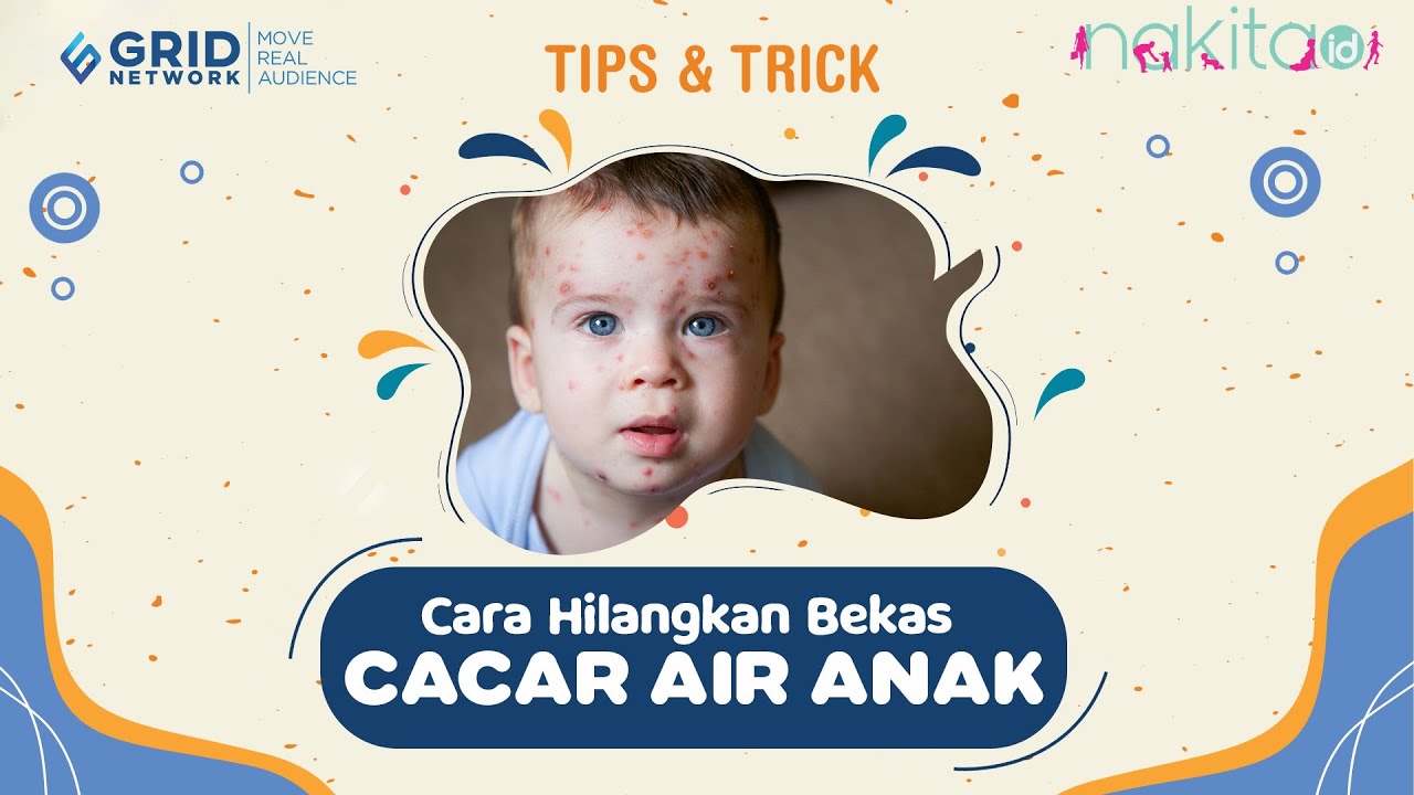 Ini Cara Ampuh Mengobati Cacar Air pada Anak 