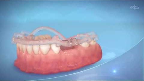 MIS MGUIDE Procedure Video