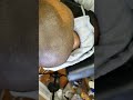 Scalp Micropigmentation, Pennsylvania