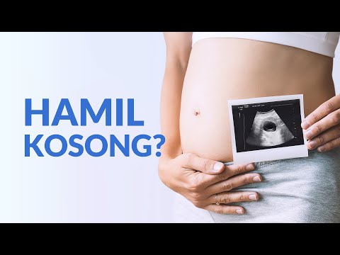Video: Apakah kehamilan samar akan terlihat pada USG?