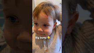 Poor James Bumped His Head On The The Wall Today