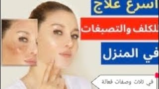 علاج الكلف في ثلاث وصفات فعالة ️‍