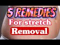 How to remove stretch mark at homehome remedies beauty tips