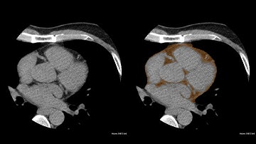 Extraction of pericardial fat from non-enhanced cardiac CT using 3D DeepLearning