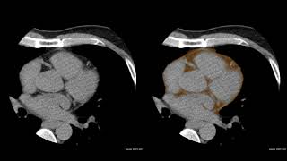 Extraction of pericardial fat from non-enhanced cardiac CT using 3D DeepLearning