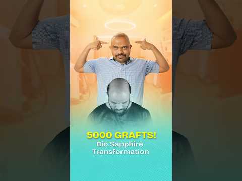 Bio-Sapphire Hair Transplant in Pune | Cost & Results #sapphirehairtransplant #shorts