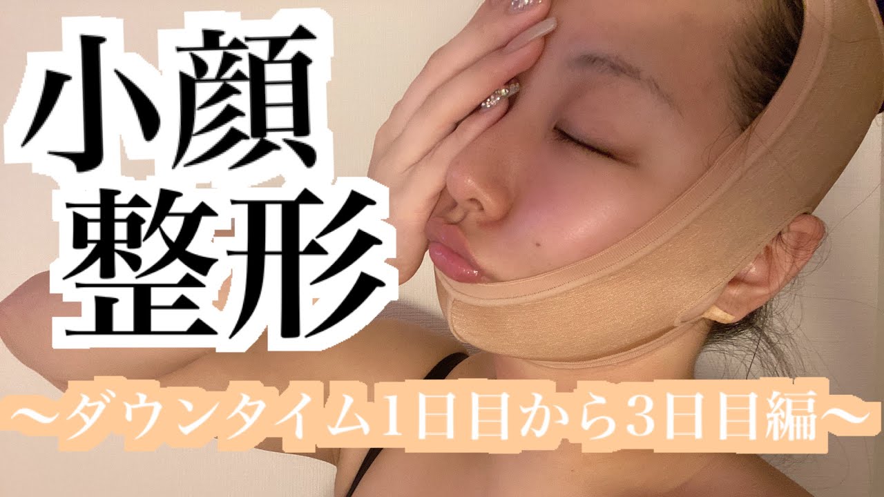 【経過報告】顔の脂肪吸引・バッカルファット・糸リフトのダウンタイムについて
