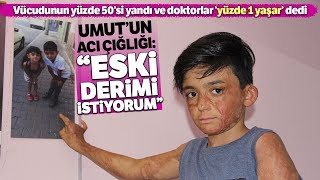 Vücudunun Yüzde 50Si Yanan Umutun Acı Çığlığı Eski Derimi İstiyorum