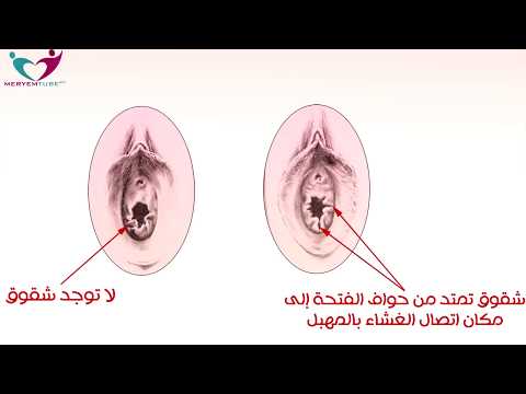 علميا الفرق بين غشاء البكاره السليم وغير السليم