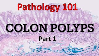 Colon Polyps | Part 1| Pathology 101