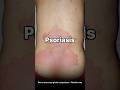 Psoriasis Case Photos (Same Area): Before vs After | Seoul