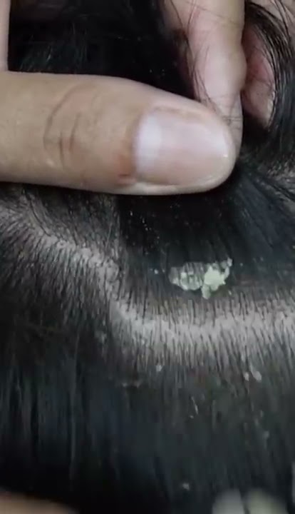 dandruff scratching addiction #64