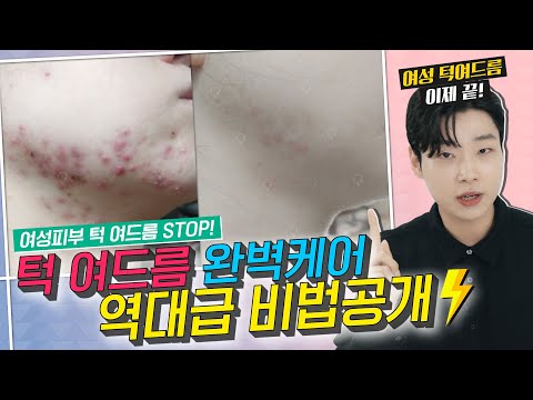 &amp;quot;여성 턱 여드름 피부 좋아지는 법!&amp;quot;✨ㅣ역대급 비법공개⚡ㅣ피부는민동성
