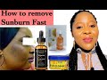 How To Remove Sunburn From Face Fast | sunburn cream |