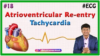 18. Taquicardia por reentrada atrioventricular e taquicardia por reentrada nodal atrioventricular