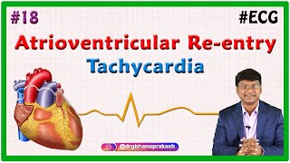 18. Atrioventricular Re-entry Tachycardia  & Atrioventricular Nodal Reentrant Tachycardia