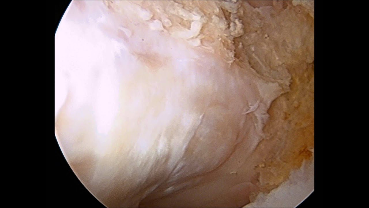 Revisión artroscópica falta de offset camera iphone 8 plus apk