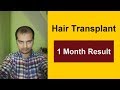 Hair Transplant Result After One Month |