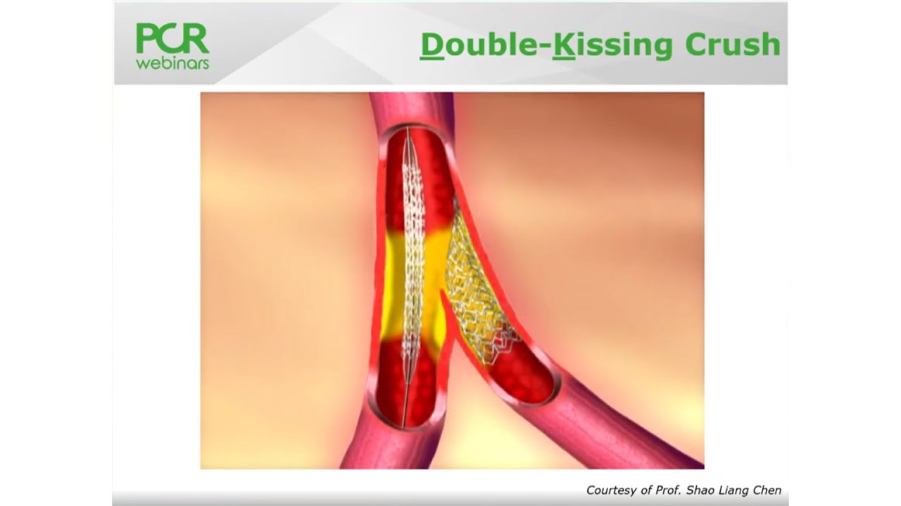 Angioplastia si stentul vascular | Proceduri medicale, durere de vena stent