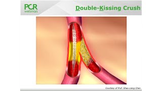 Case-based step-by-step DK-crush technique in a bifurcation - Round Table Webinar