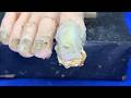 Ingrown toenails with onychomycosis, toenails have fungus black mud 4517
