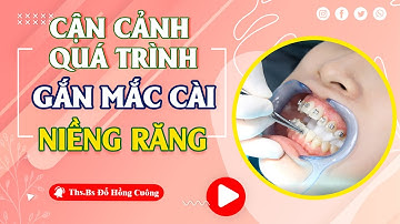 Cận Cảnh Quá Trình Gắn Mắc Cài Niềng Răng