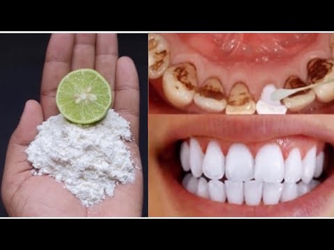 Video: Što je u stomatologiji skaliranje?