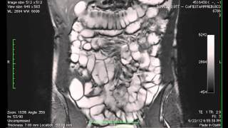 Cine Mr Imaging Of The Small Intestine In A Case Of Bowel Mri