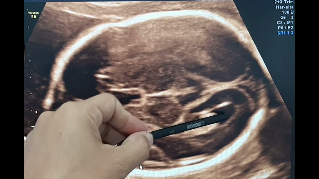 Neurosonography Review. Transventricular Section