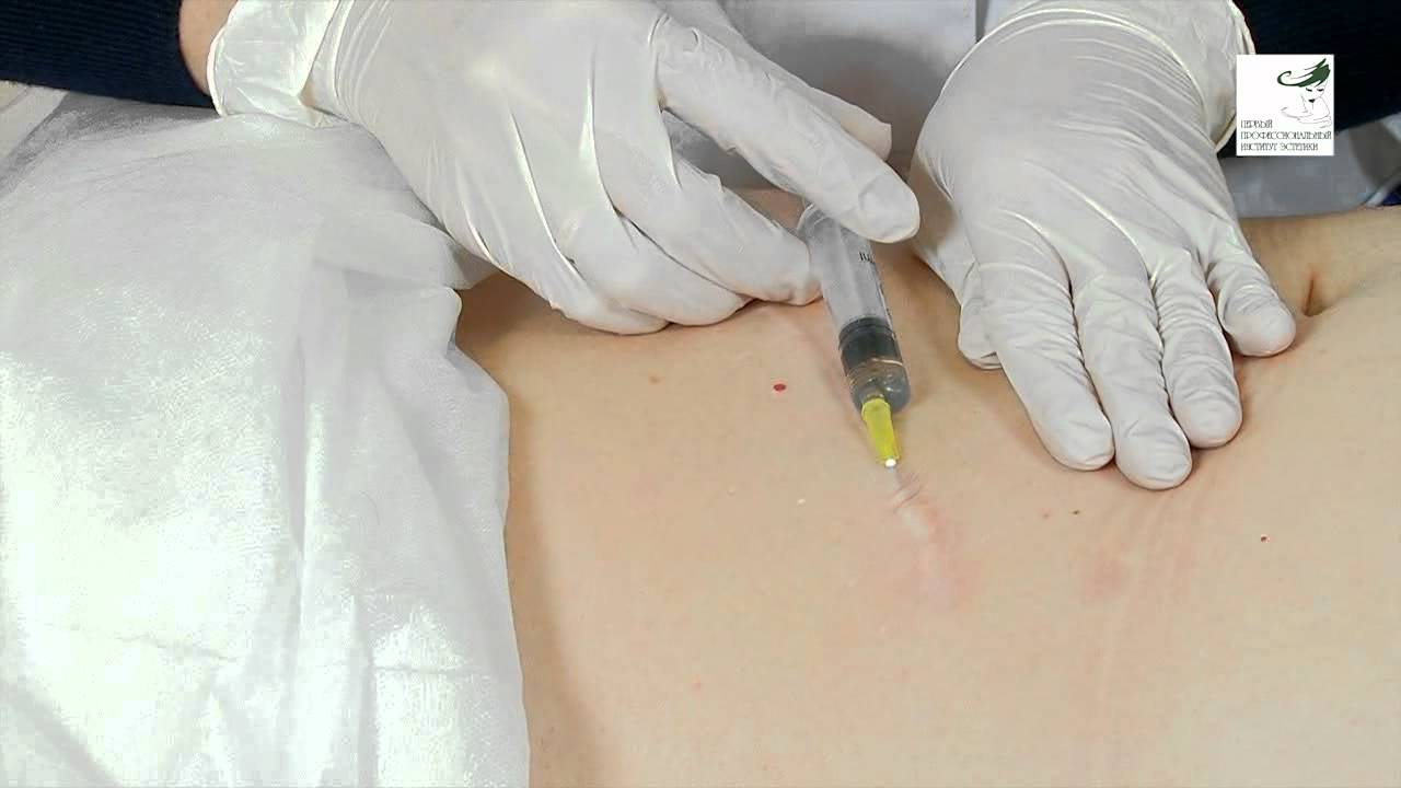 Мезотерапия тела