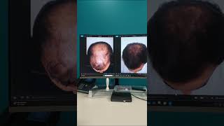 Hair transformation Program