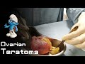 Hair in the ovarian teratoma